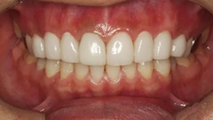 ラミネートベニア+オールセラミッククラウン施術後