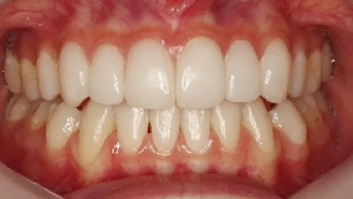 ラミネートベニア+歯肉整形施術後