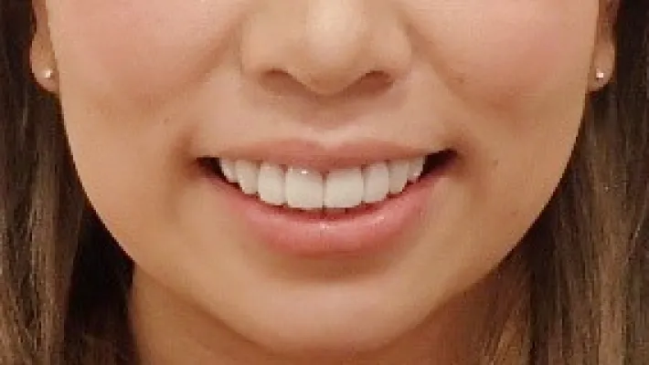 ラミネートベニア+歯肉整形施術後