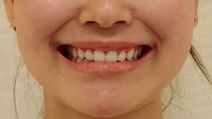 ラミネートベニア+歯肉整形施術前