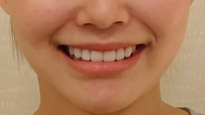 ラミネートベニア+歯肉整形施術後