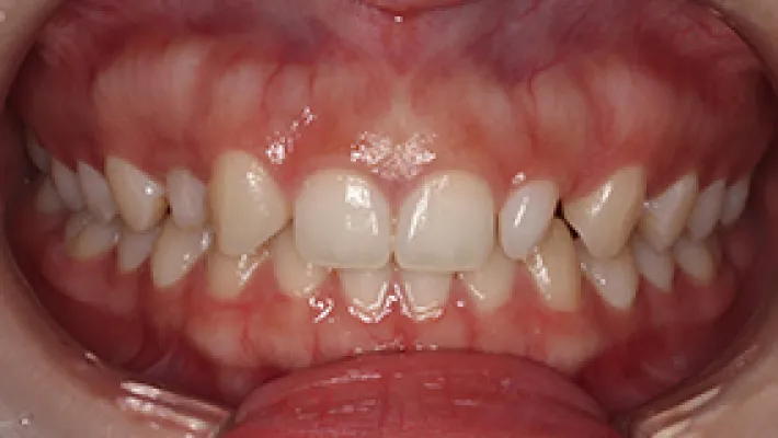 ラミネートベニア施術前1