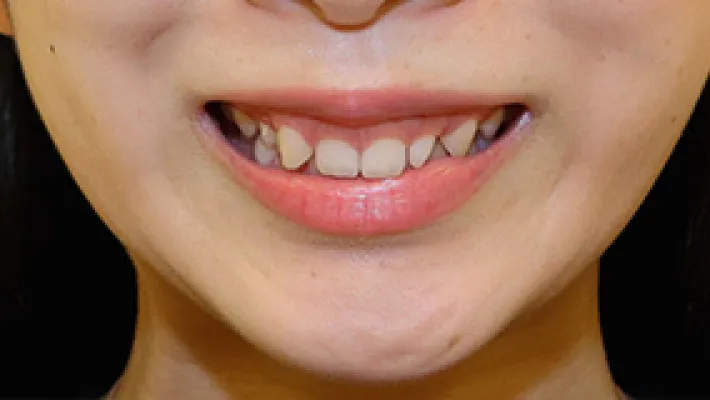 ラミネートベニア施術前2