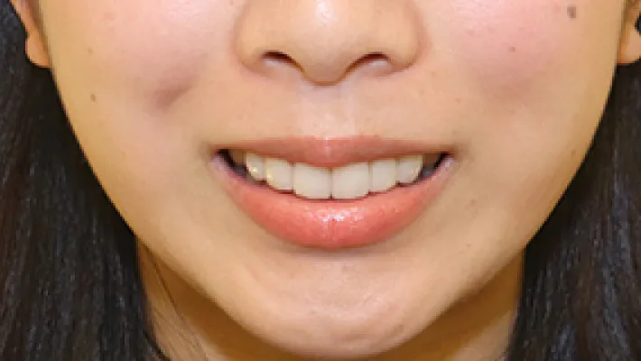 ラミネートベニア施術後2