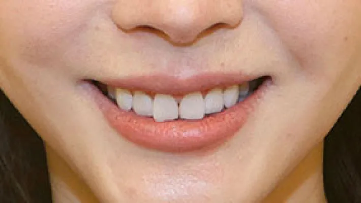 ラミネートベニア施術前