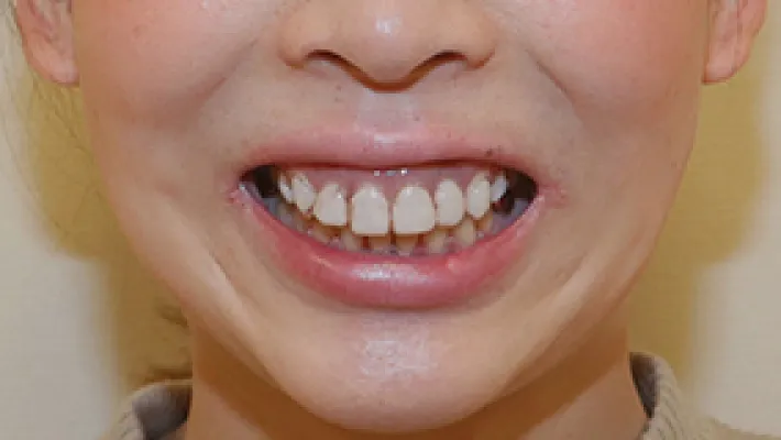 オールセラミッククラウン+歯肉整形施術前