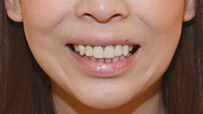 オールセラミッククラウン+歯肉整形施術後