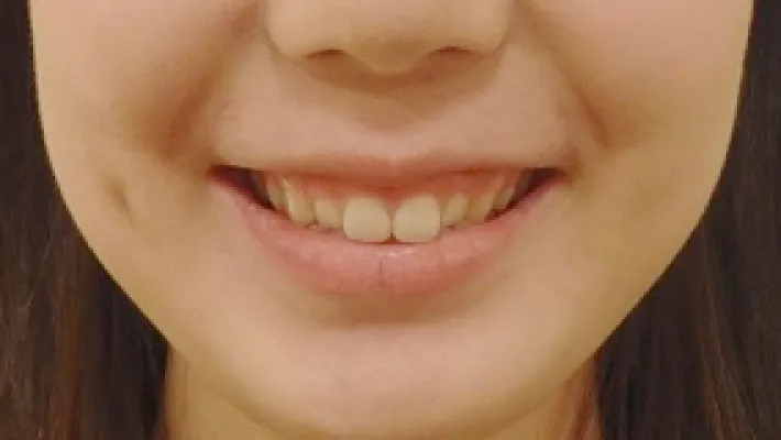 ガミースマイル施術前