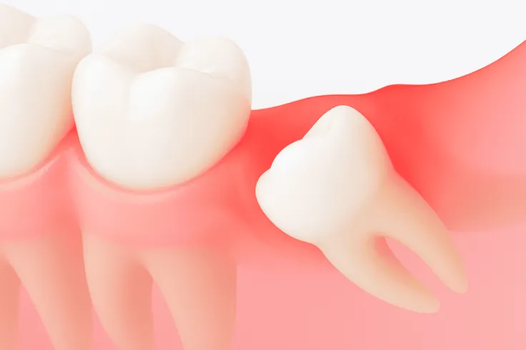 親知らずの腫れ