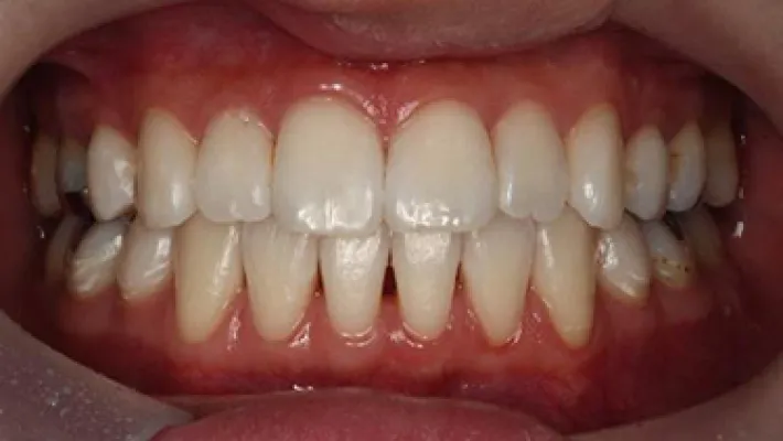 ホワイトニング施術後