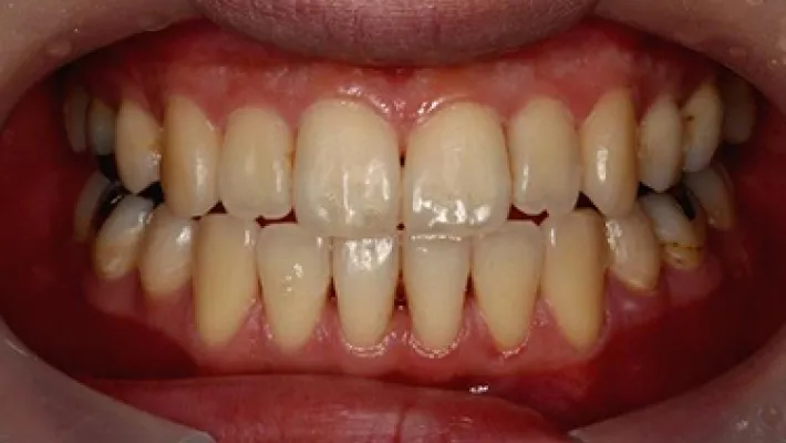 ホワイトニング施術前