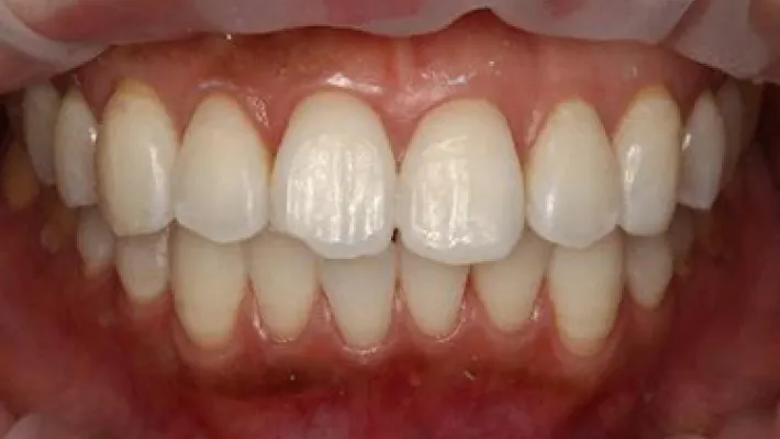 ホワイトニング施術後