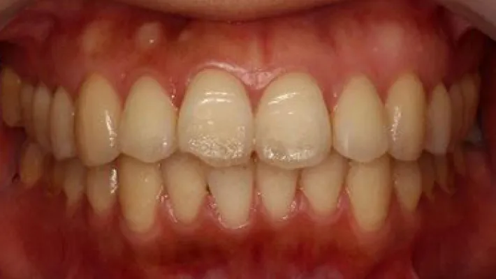 ホワイトニング施術前