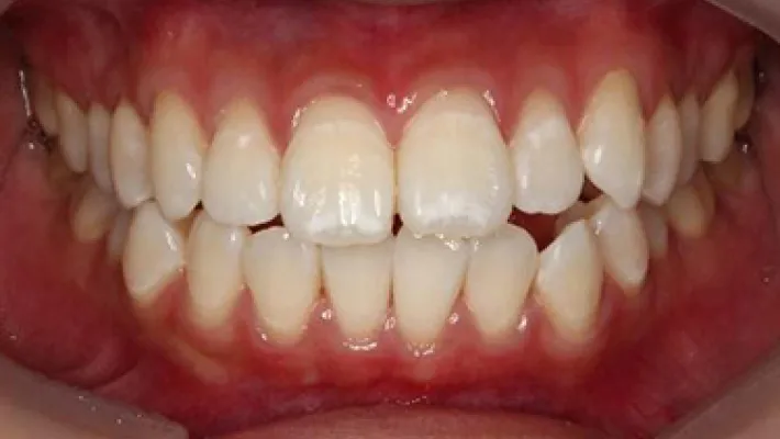 ホワイトニング施術後