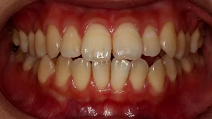 ホワイトニング施術前