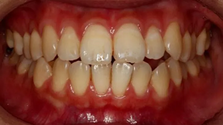 ホワイトニング施術前