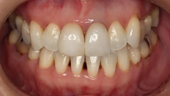 ホワイトニング施術後