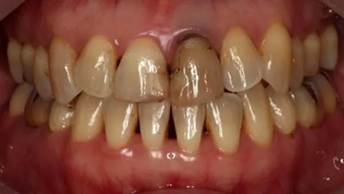 ホワイトニング施術前