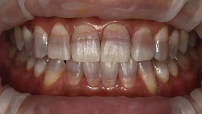 テトラサイクリン歯施術後