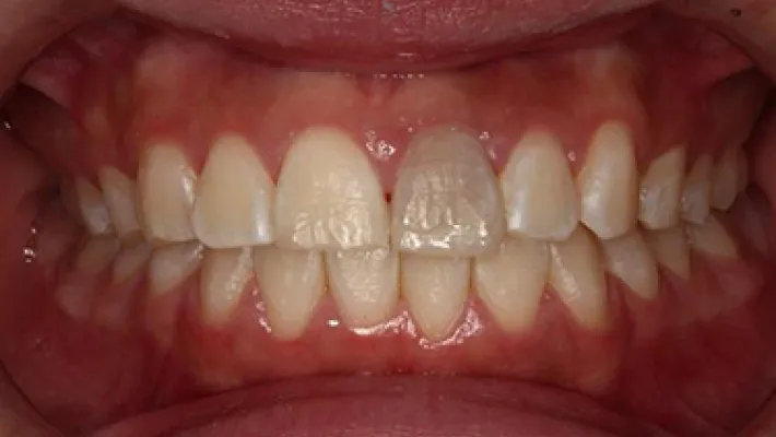 失活歯ホワイトニング施術前
