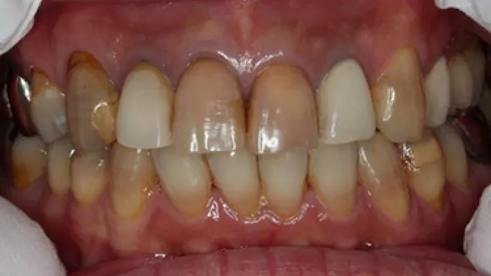 インターナルブリーチ施術後