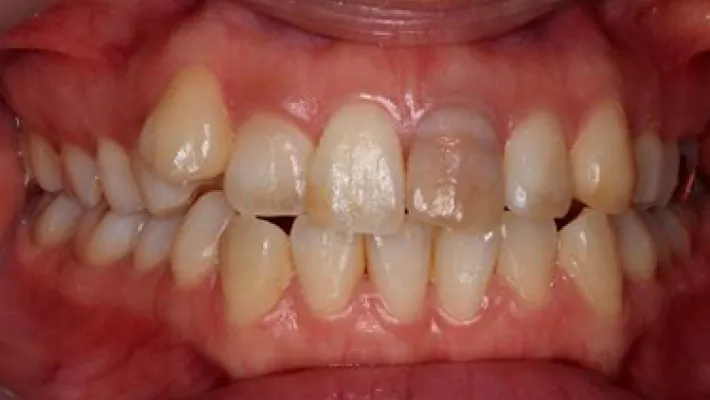 インターナルブリーチ施術前