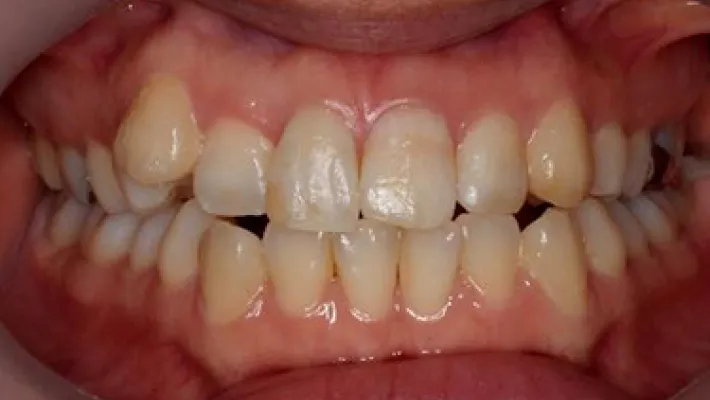 インターナルブリーチ施術後