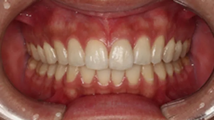 ホワイトニング施術後